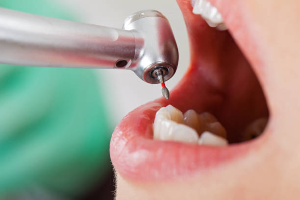 Best Emergency Tooth Extraction in Iva, SC